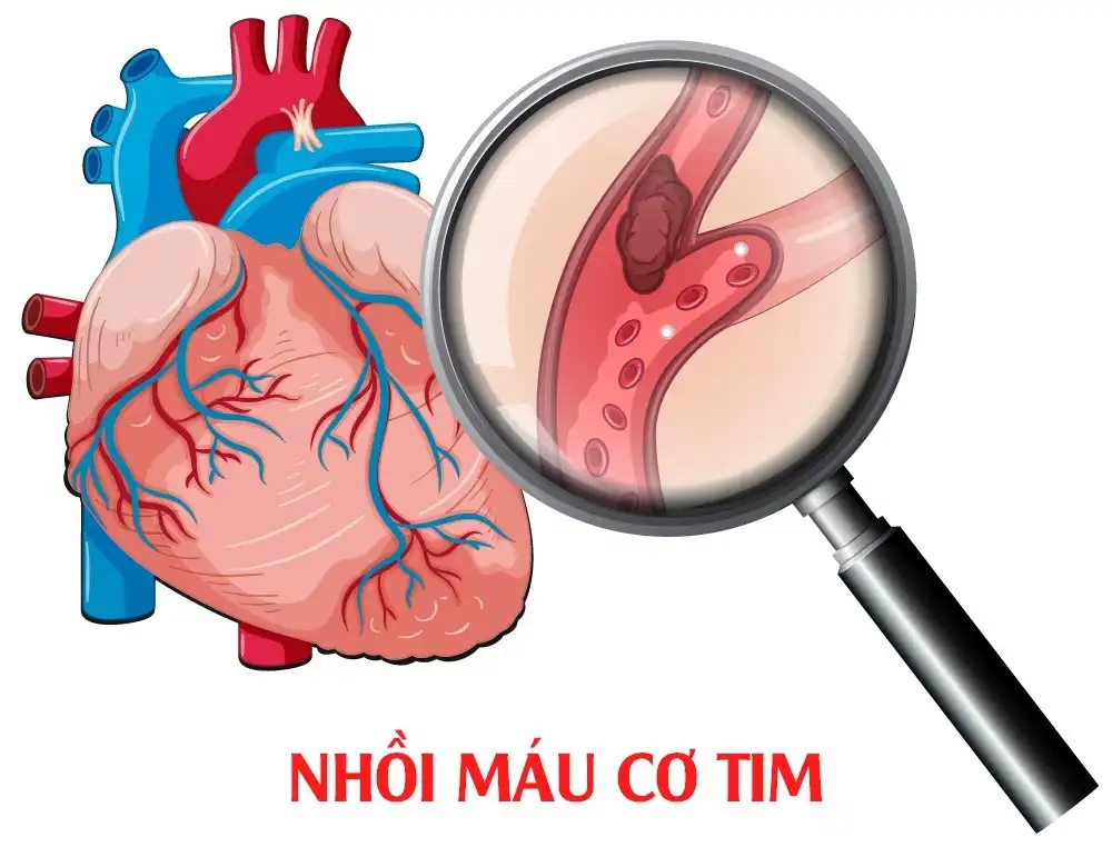 dấu hiệu nhồi máu cơ tim